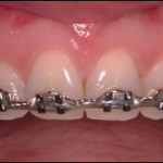 Tooth Reshaping