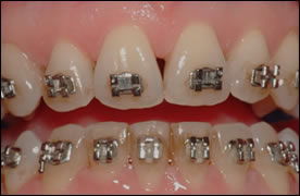 Tooth Reshaping