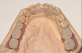 Often implants can be esthetically managed from the outset if all requirements exist. This requires proper implant position, soft tissue management and proper tooth emergence. This is most often the case when posterior implants are concerned.