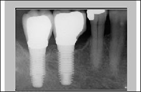 Simple Posterior Implants