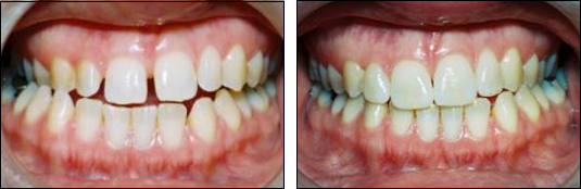 Simple Veneers